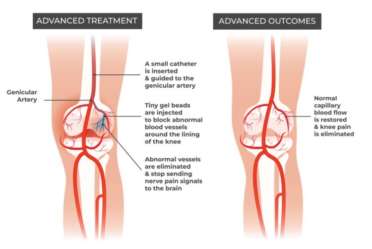 Understanding Genicular Artery Embolization for Knee Pain Relief | Flowcare