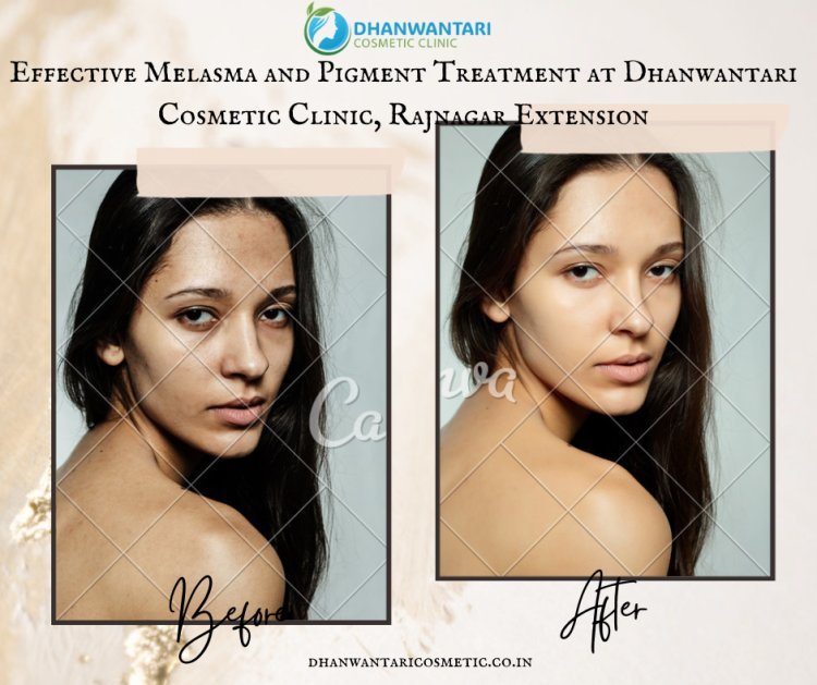 Effective Melasma and Pigment Treatment at Dhanwantari Cosmetic Clinic, Rajnagar Extension