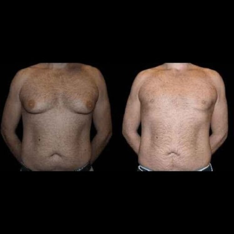 Gynecomastia and Its Impact on Relationships in Dubai