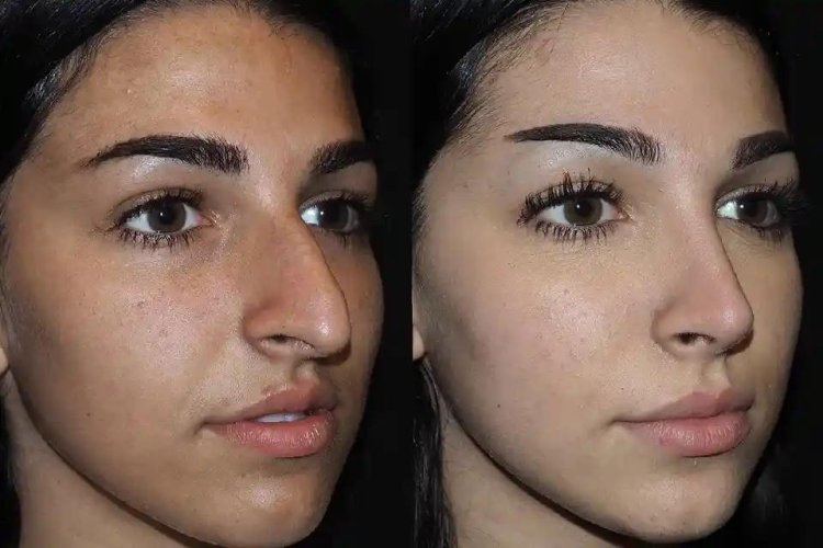 Expert Rhinoplasty in Dubai for a Perfectly Sculpted Nose