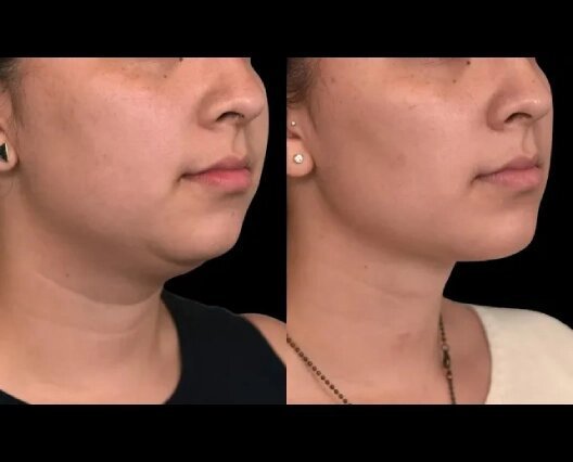 How to Sculpt Your Jawline with Double Chin Removal in Dubai