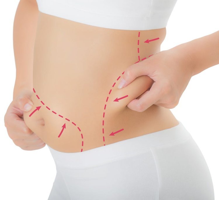 How to Support Your Body's Natural Healing Process After Tummy Tuck in Dubai