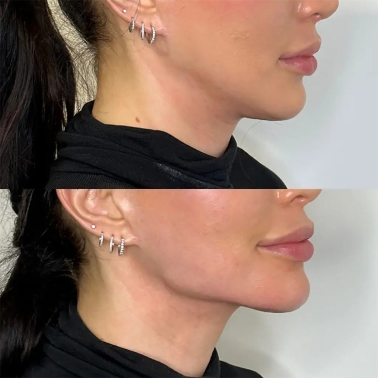 Jawline Fillers Injections in Dubai: Achieving a Defined Jawline