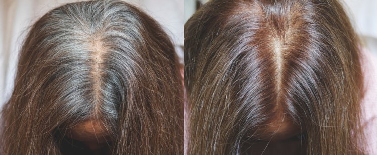 Best Grey Hair Treatment in Chennai