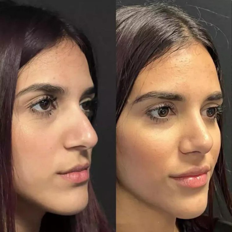 What Patients Say About the Best Rhinoplasty Surgeon in Dubai