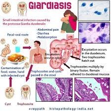 How to Prevent Giardiasis: Simple Tips for Staying Healthy?