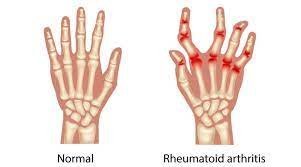 Does Rheumatoid Arthritis Cause Muscle Pain?