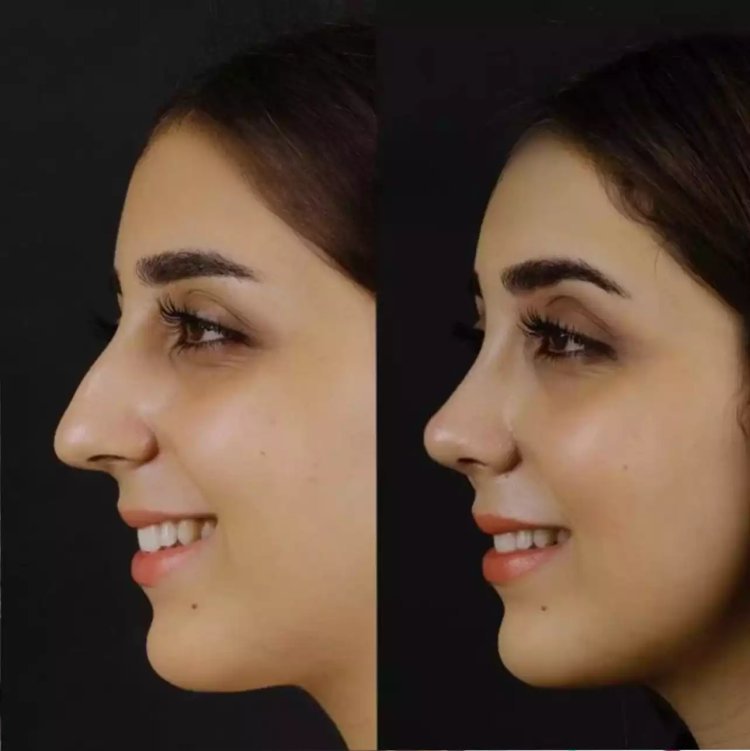 How Effective Is Nose Deviated Septum Surgery in Dubai?