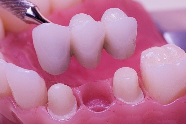 Dentures - A Cost-Effective and Reliable Solution to Missing Teeth