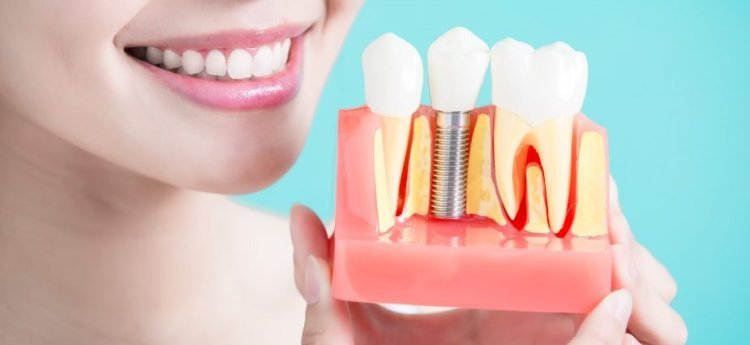 Dental Crowns and Dental Implants Explained