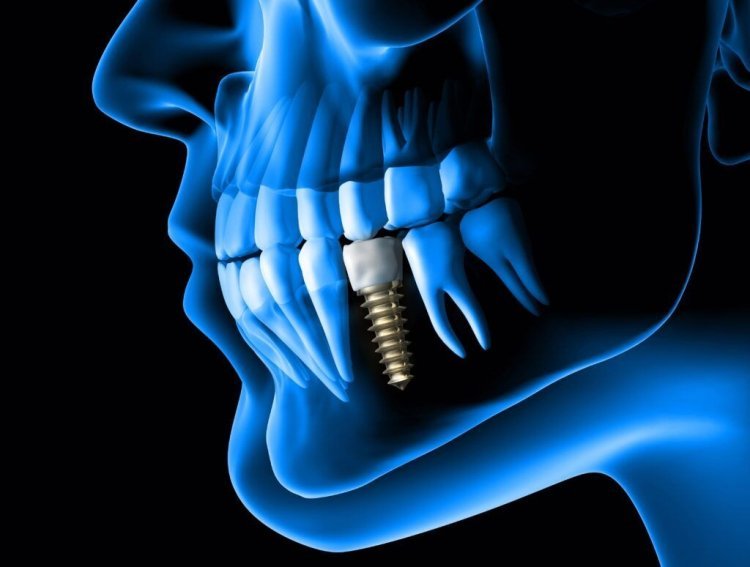 Dental Implant Dentist - Why Choose Dental Implants?