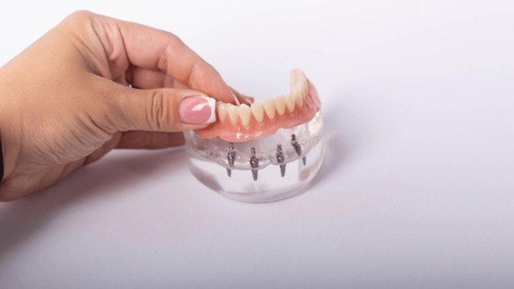 Dental Implants in Houston: Restoring Your Smile and Oral Health