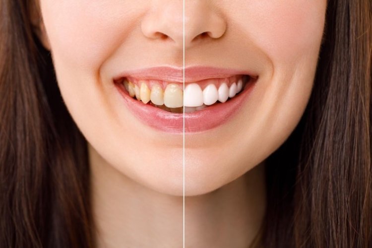 How Teeth Whitening Can Transform Your Smile