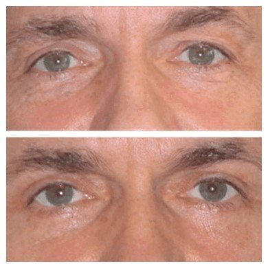 Eye Bag Removal and Aging: Insights from the Best Eye bag removal Surgeons in dubai