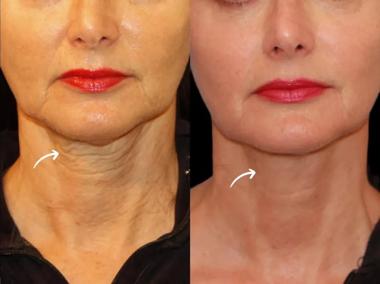 Sculptra vs. Botox: Insights from the Best Doctors in dubai