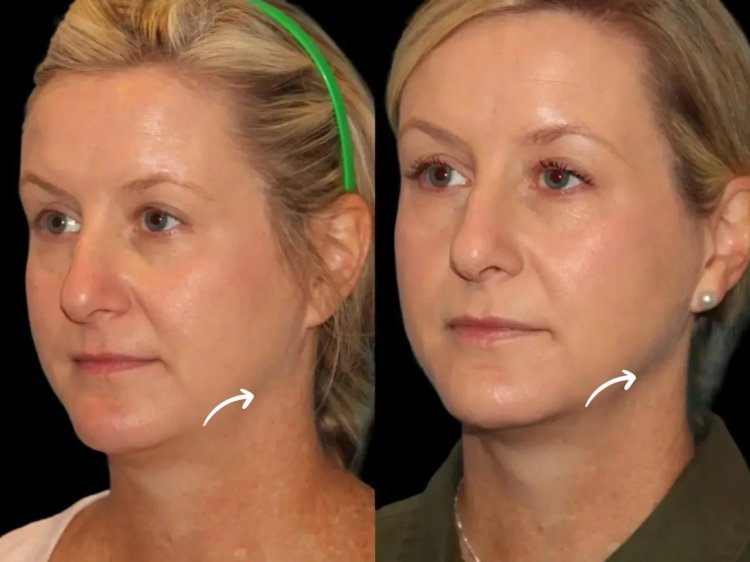 The Advantages of Sculptra Fillers in Dubai Over Other Facial Treatments